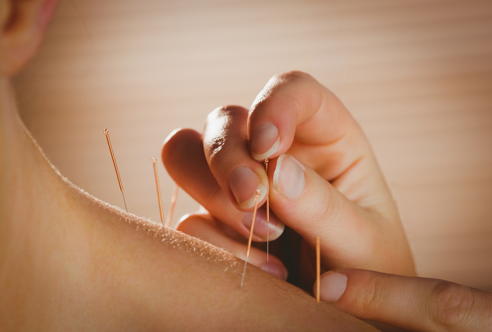 Young,Woman,Getting,Acupuncture,Treatment,In,Therapy,Room